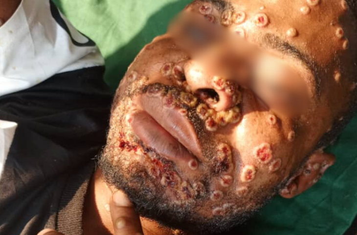Le Monkeypox sévit dans 23 des 26 provinces du pays, avec une augmentation exponentielle
