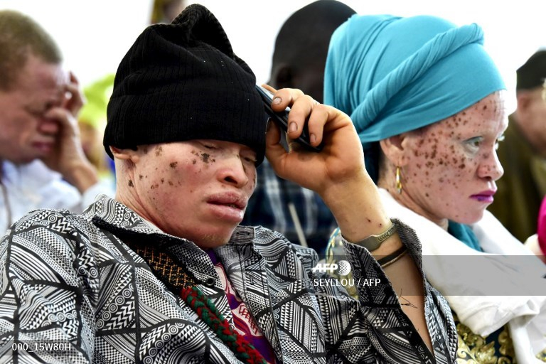 Kinshasa : la fondation Mwimba Texas aide les albinos à se mettre en confiance