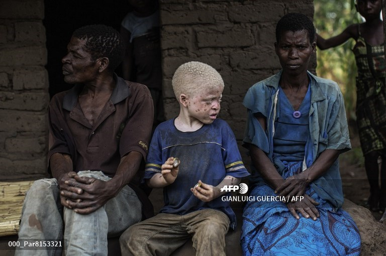 Kongo-central : lutte contre les préjugés sur l’albinisme